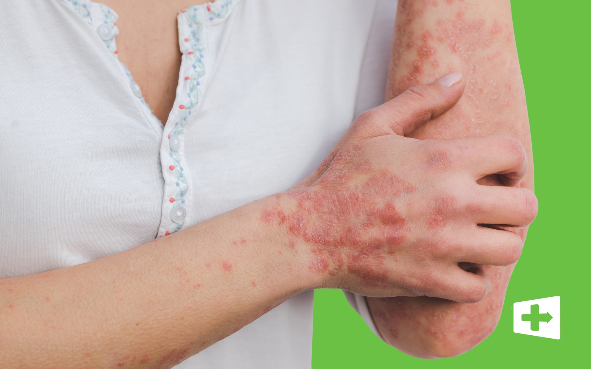 Let’s Talk Psoriasis: It’s Time to Clear Up the Confusion (and the Skin!)