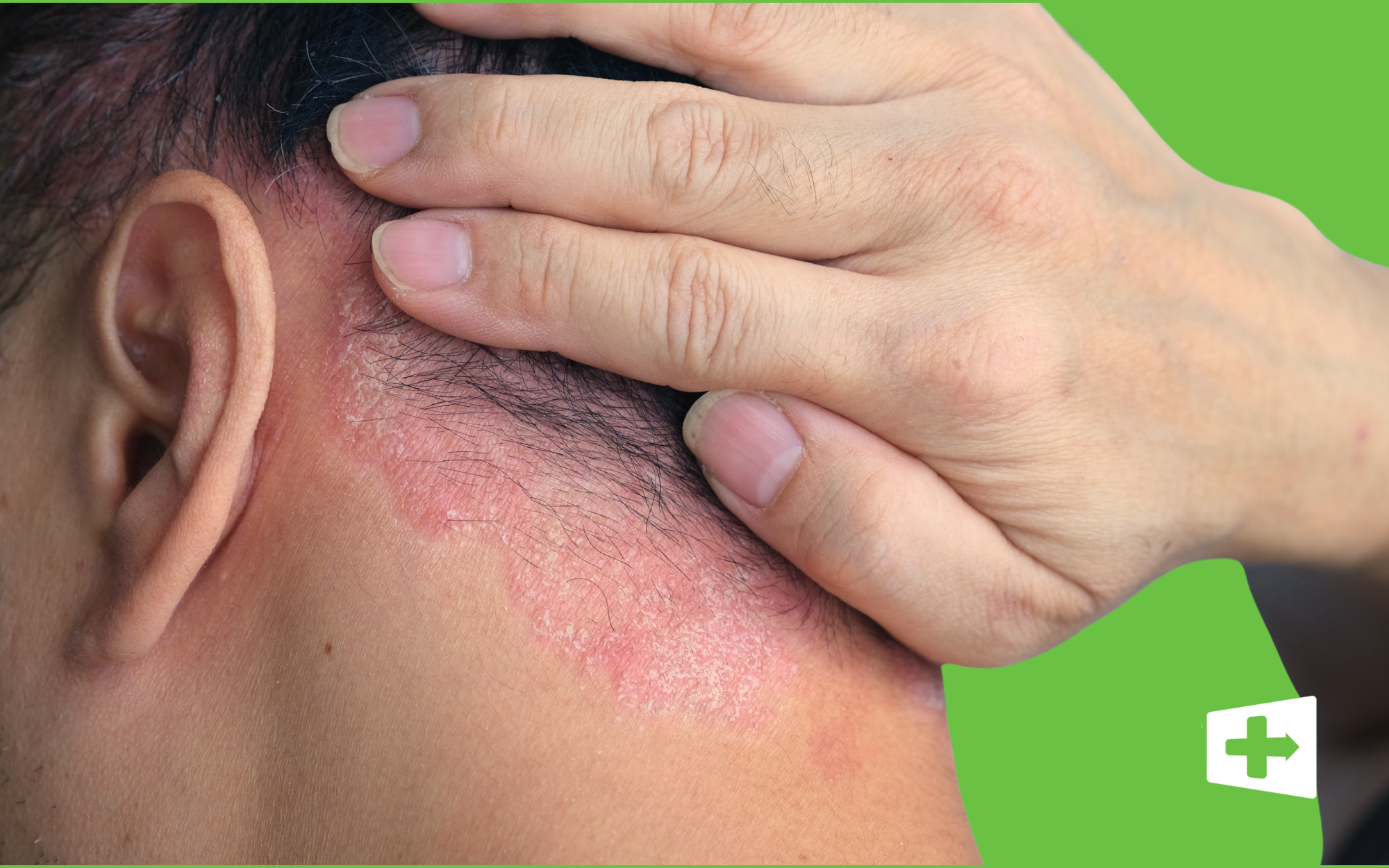 Psoriasis 101: What You Need to Know