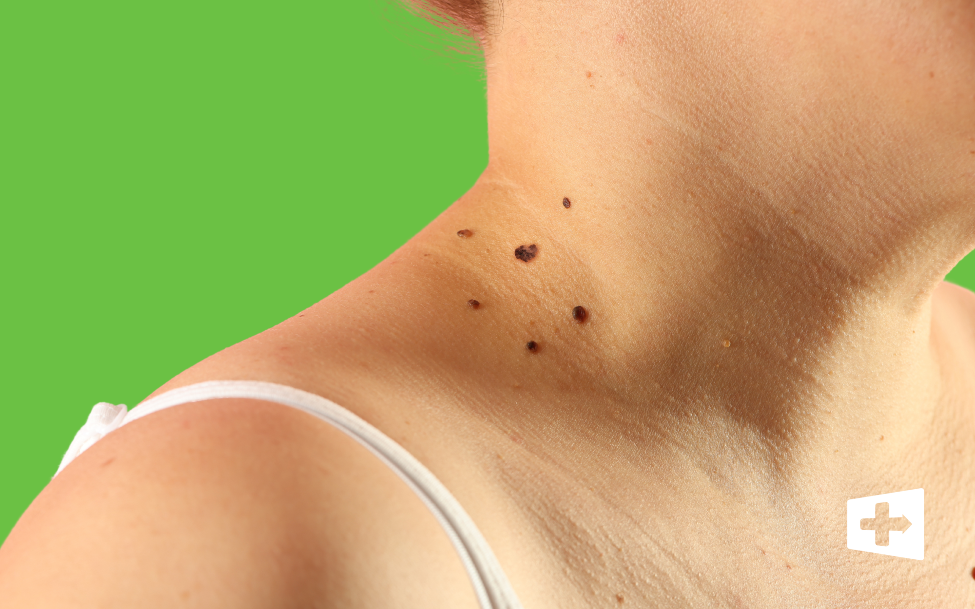 Melanoma Awareness Month: This Is Your Moment to Act